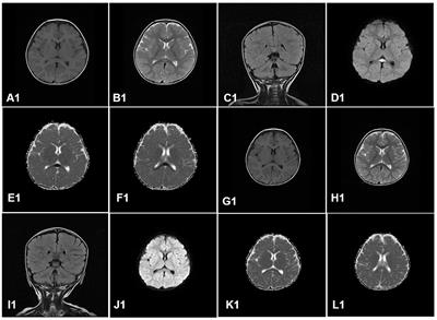 Reversible splenial lesion syndrome in children: a retrospective study of 130 cases